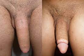 File:Adult circumcision before and after (2).jpg - Wikimedia Commons
