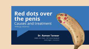 Red dots over the penis: Allergic Balanitis causes and treatment - YouTube