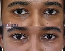under eye filler dark circles before