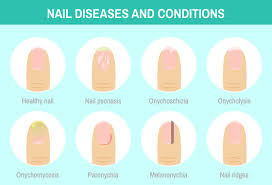nail diseases images browse 896