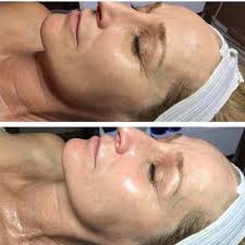 The Skin Room - Fire & Ice facial 🔥❄️ Before and After the award winning  fire and ice skin resurfacing treatment 😍 book in for yours today 🙌🏼  RESULTS OF A PEEL