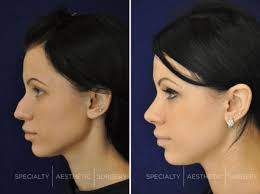 how long is recovery from a nose job