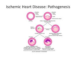 Ischemic Heart Diseases Ppt Video Online Download