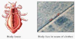 body lice