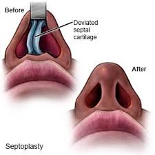septoplasty discharge care