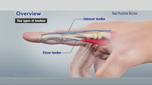 If the glute is weak, it can be sluggish, leaving the hip. Flexor Tendon Injuries Video Medical Video Library
