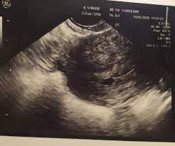 Der embryo ist auf dem ultraschall zu dieser zeit oft noch nicht zu erkennen. 6 Ssw Nichts Zu Sehen Babyforum At
