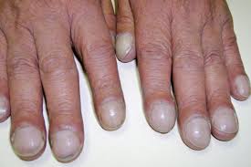 clubbed fingers and nails causes and