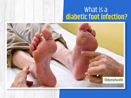 diabetic foot infection symptoms risk