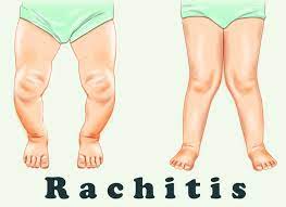 Rachitis - Klapperstorch
