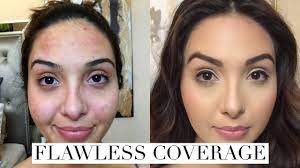 cover acne breakouts dark spots
