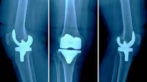 knee replacement complications