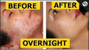 remove pimple or dark spot in 1 day