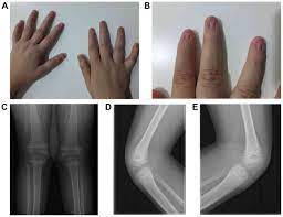 nail patella syndrome with early onset