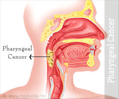 The three main types of throat cancer are oropharyngeal cancer. Throat Cancer Pharyngeal Cancer Types Causes Symptoms Diagnosis And Treatment