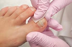 identifying when your ingrown toenail