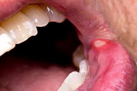 canker sores what causes them and how