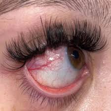 lash extension allergy