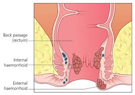 The bulges around the internal hemorrhoid are external hemroids. Piles General Information Embarrassing Problems