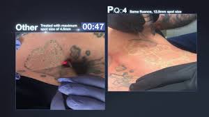 tattoo removal in tucson perfection