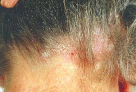 red spots on scalp causes treatment