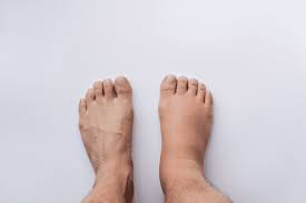 post surgical edema treatments