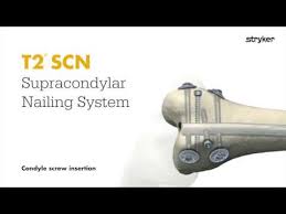 t2 supracondylar scn nail condyle