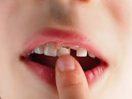 Nhổ răng sữa bị gãy chân có ảnh hưởng đến việc mọc răng?