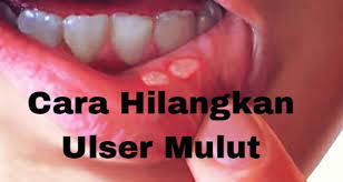 Kenapa ulser mulut kerap terjadi? 8 Petua Mudah Dan Berkesan Menghilangkan Ulser Mulut Kifarah Media