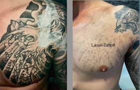 tattoo removal sydney best tattoo