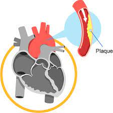 cardiology coronary artery disease