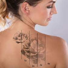 tattoo removal south hills