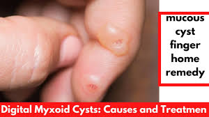 mucous cyst finger home remedy