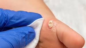 warts dermatology onewelbeck skin