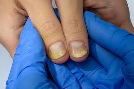 nail psoriasis severity index napsi