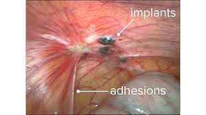 Patches are often attached to the ovaries, fallopian. Endometriosis Adhesions Symptoms Formation And Pictures