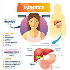 jaundice causes risk factors