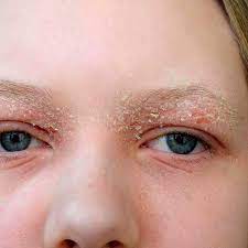 eyelid dermais most skincare