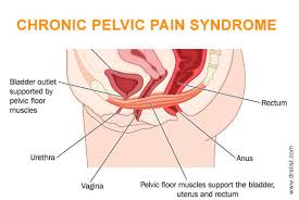 chronic pelvic pain syndrome