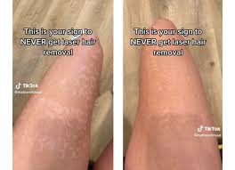 laser hair removal woman s scary scars