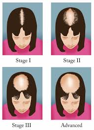 Female pattern baldness affects women in their twenties the same way alopecia affects men. Female Pattern Baldness Healthdirect