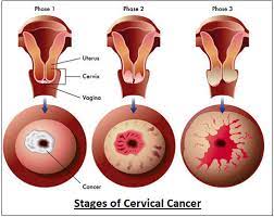 pap smear pap test why it is done