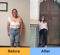 before and after weight loss surgery
