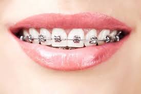 how to prevent white spots from braces