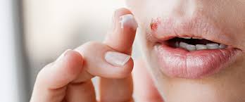 lippenherpes symptome behandlung