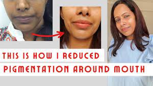 removed pigmentation around mouth