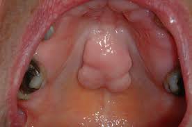 13 lumps and swellings in the palate