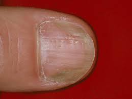 white spots on nails causes