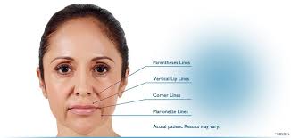 mouth and nose area wrinkle treatment