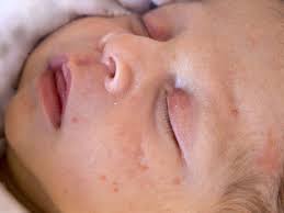 baby acne causes diagnosis and treatment